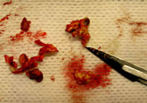 Curetage de l'abc&egrave;s.