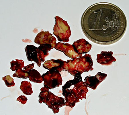 Ce qui a &eacute;t&eacute; extrait de la joue.