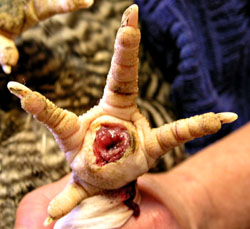 Curetage de l'abc&egrave;s.