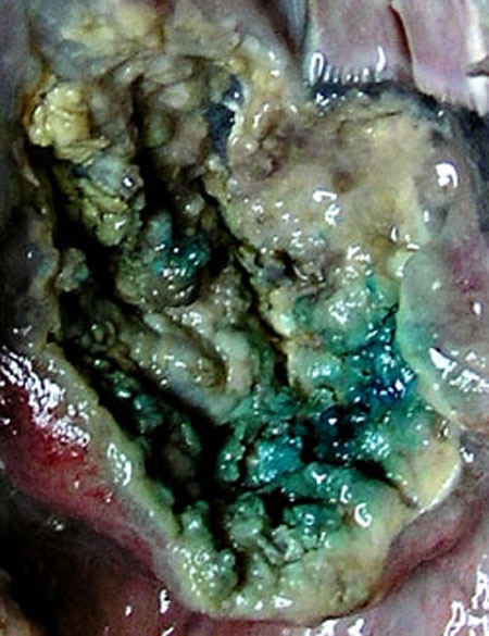 Vue rapproch&eacute;e de la masse purulente dans le gosier.